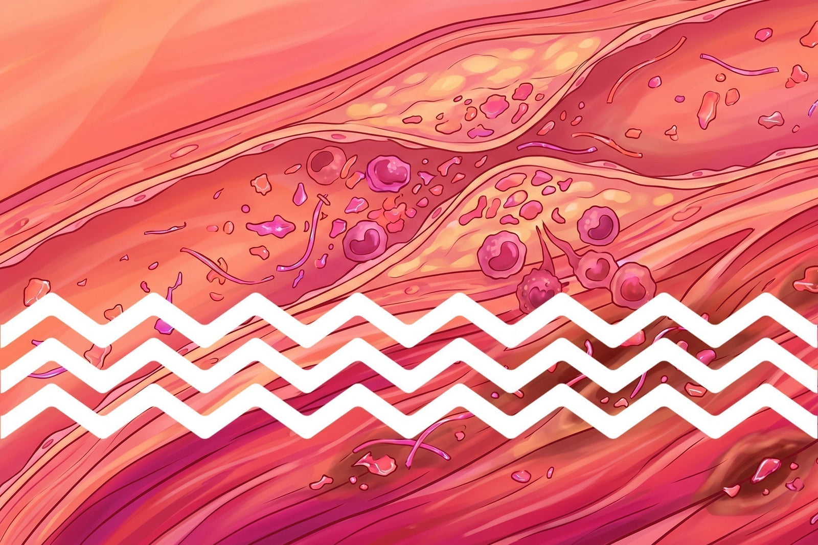 Potential link between microplastics and cardiovascular disease.